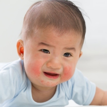 Tak Cepat Diobati, Alergi Bisa Ganggu Kecerdasan Anak